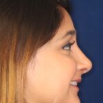 Closed Rhinoplasty - Right Profile - After Pic - Removal of hump and nose tip refined - Best Rhinoplasty Beverly Hills
