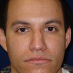 Closed Rhinoplasty - Lowering of Bridge, raising and refining nose tip - Headshot Face- Before Pic - Top Rhinoplasty Surgeon