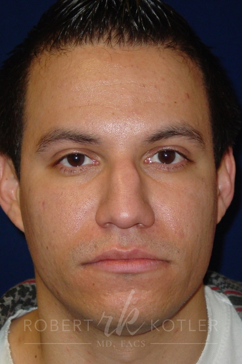 Closed Rhinoplasty - Lowering of Bridge, raising and refining nose tip - Headshot Face- Before Pic - Top Rhinoplasty Surgeon