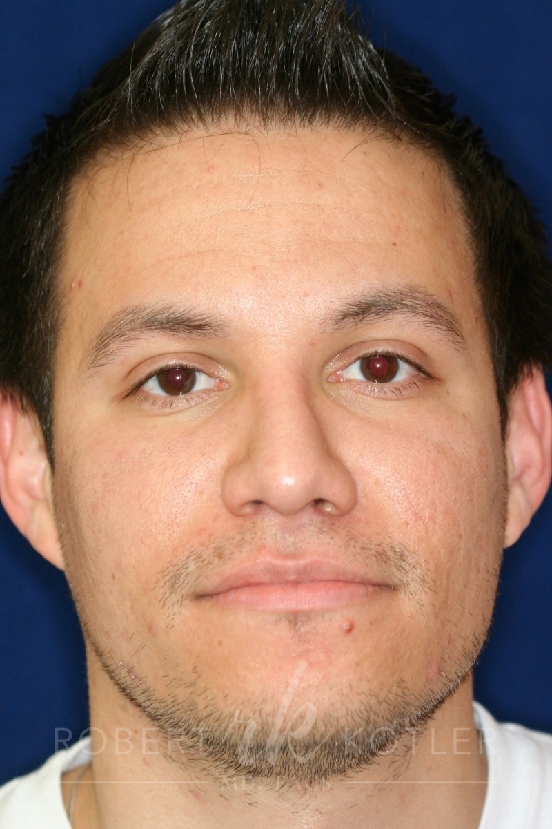 Closed Rhinoplasty - Lowered Bridge, raised and refined tip - Headshot Face- After Pic - Beverly Hills Rhinoplasty Superspecialist