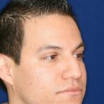 Closed Rhinoplasty - Lowered Bridge, raised and refined tip - Right Profile - Before Pic - Best Rhinoplasty Beverly Hills