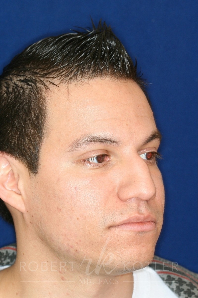 Closed Rhinoplasty - Lowered Bridge, raised and refined tip - Right Profile - Before Pic - Best Rhinoplasty Beverly Hills
