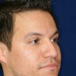 Closed Rhinoplasty - Lowered Bridge, raised and refined tip - Right Profile -After Pic - Rhinoplasty Surgeon in Beverly Hills