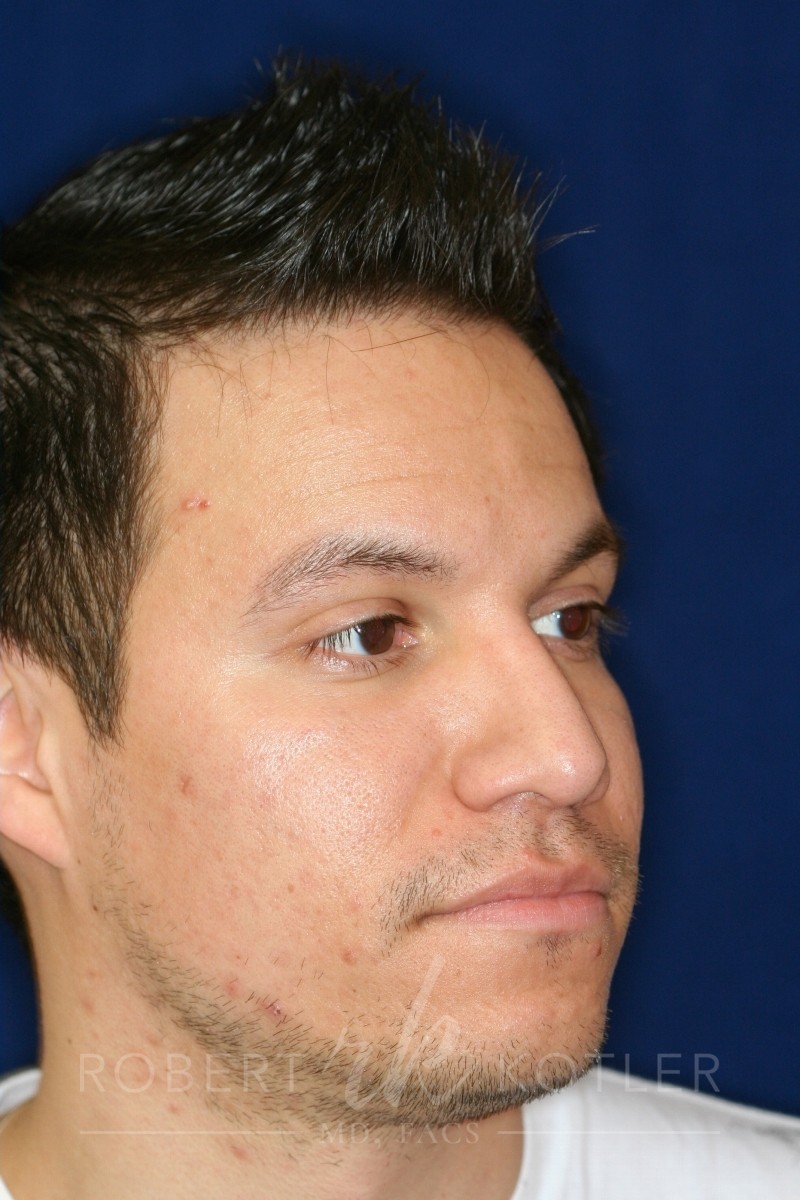 Closed Rhinoplasty - Lowered Bridge, raised and refined tip - Right Profile -After Pic - Rhinoplasty Surgeon in Beverly Hills