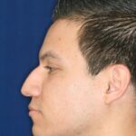 Closed Rhinoplasty - Lowering of Bridge, raising and refining nose tip - Left Profile - Before Pic - Nose Job in Beverly Hills