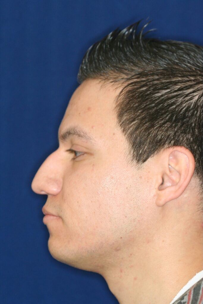 Closed Rhinoplasty - Lowering of Bridge, raising and refining nose tip - Left Profile - Before Pic - Nose Job in Beverly Hills
