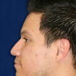 Closed Rhinoplasty - Lowering of Bridge, raising and refining nose tip - Left Profile - After Pic - Best Nose Job Surgeon