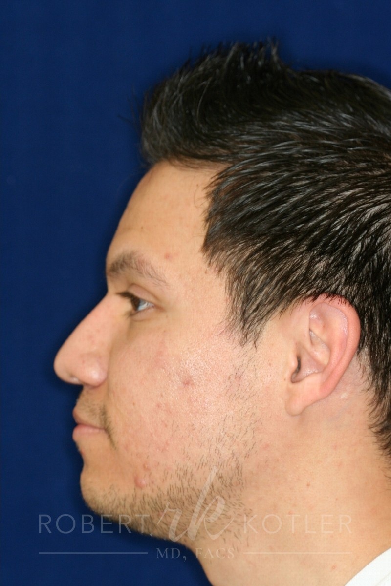 Closed Rhinoplasty - Lowering of Bridge, raising and refining nose tip - Left Profile - After Pic - Best Nose Job Surgeon