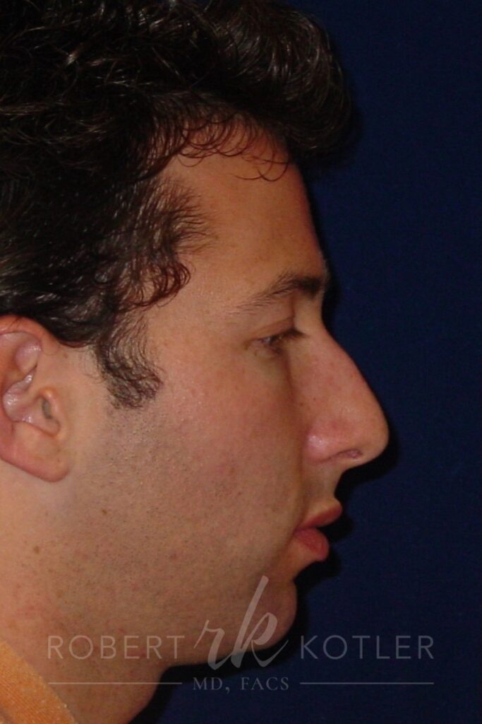 Closed Rhinoplasty - Right Profile - Before Pic - Hump Removal - Tip refinement - nose elevated from lip - Top Rhinoplasty Surgeon