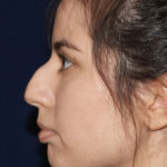 Closed Rhinoplasty - Left Profile - Before Pic - Hump removal - tip refinement - nose recessed closer to face - Rhinoplasty Surgeon in Beverly Hills