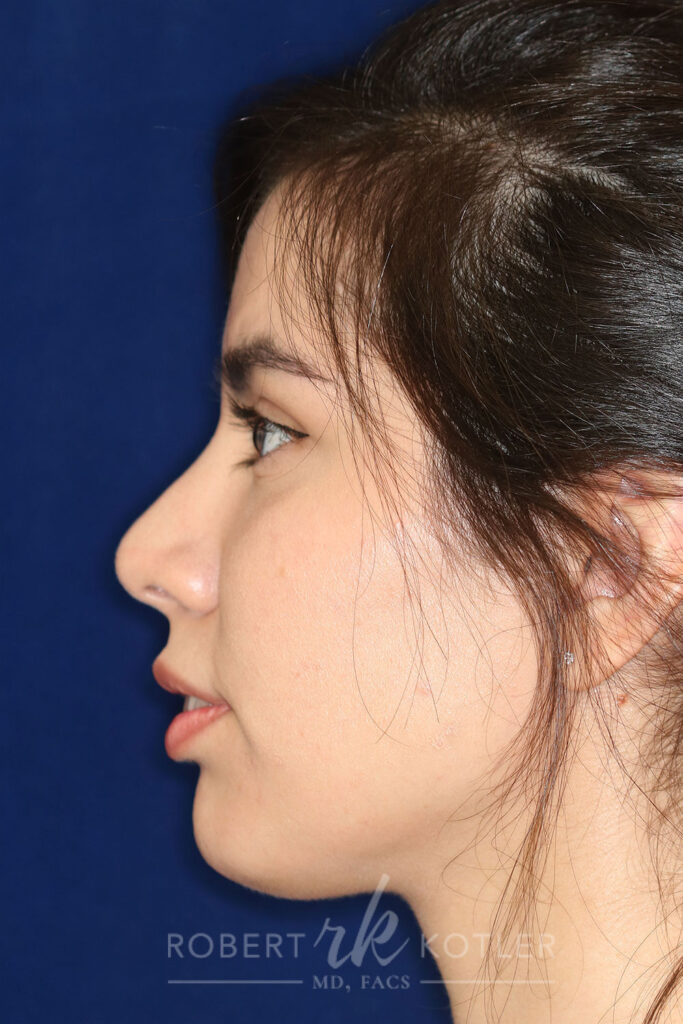 Closed Rhinoplasty - Left Profile - After Pic - Hump removal - tip refinement - nose recessed closer to face - Nose Job in Beverly Hills