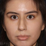 Closed Rhinoplasty - Front Face View - Before Pic - Hump removal - tip refinement - nose recessed closer to face - Best Nose Job Surgeon