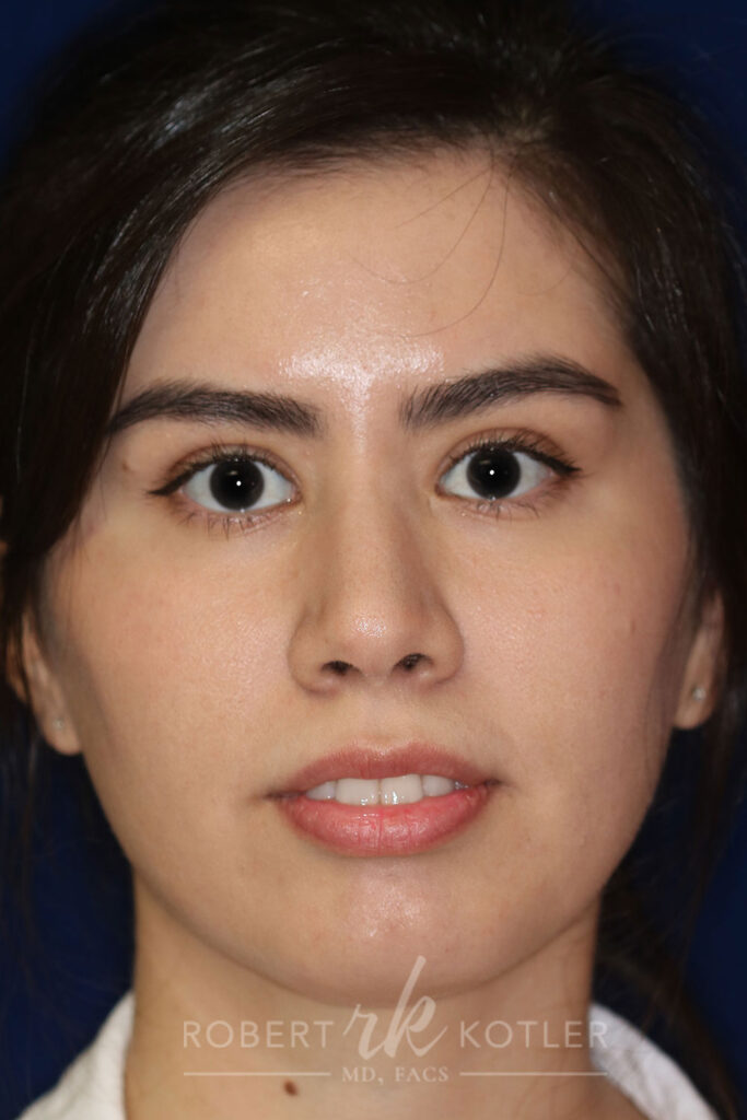 Closed Rhinoplasty - Front Face View -After Pic - Hump removal - tip refinement - nose recessed closer to face - Top Rhinoplasty Surgeon