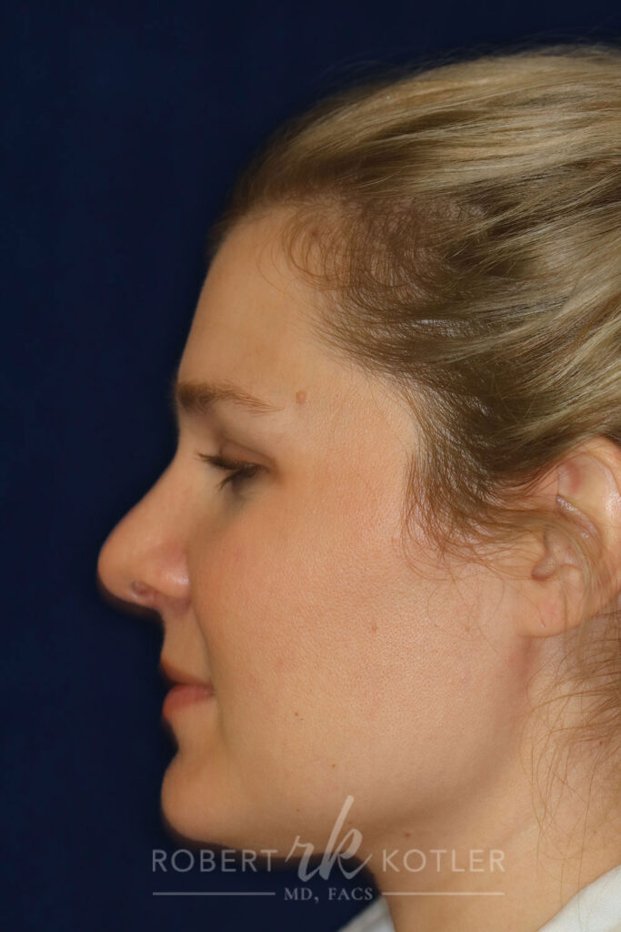 Rhinoplasty - Left Profile - After pic - Hump removal - Bulbous nose tip refinement and recession - Nose Job in Beverly Hills