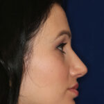 Rhinoplasty - Right Profile - After Pic - Hump removal, tip refinement - Crooked nose correction - Beverly Hills Rhinoplasty Superspecialist