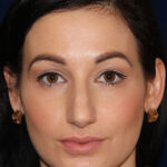 Rhinoplasty - Front Face View - Before Pic - Hump removal - tip refinement - Crooked nose correction - Best Rhinoplasty Beverly Hill