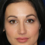 Rhinoplasty - Front Face View - After Pic - Hump removal - tip refined - Crooked nose corrected - Rhinoplasty Surgeon in Beverly Hills