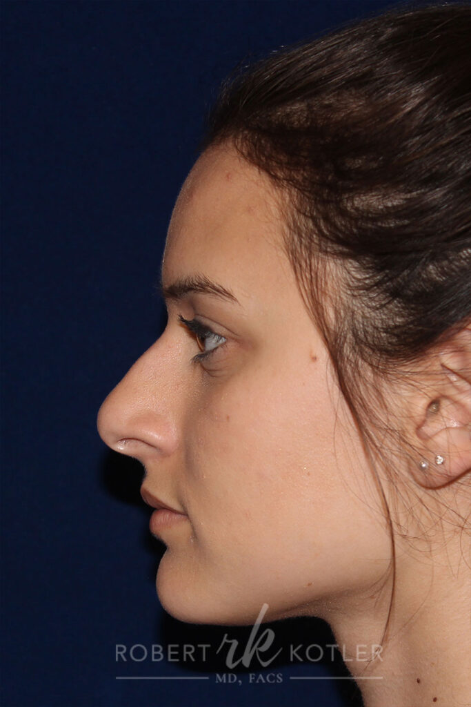 Rhinoplasty - Left Profile - Before Pic - Hump removal - Nose elevated - Tip refined - nostrils made smaller - Best Nose Job Surgeon