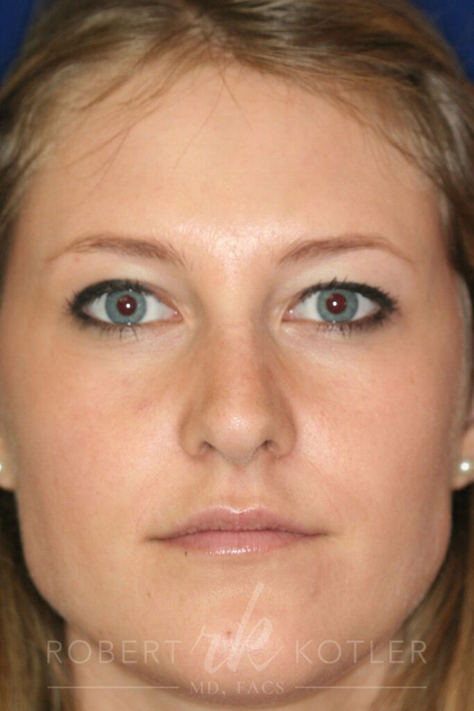 Closed Rhinoplasty - Front Face view - After Pic - Hump removal - Nose tip refinement -Nose Job in Beverly Hills