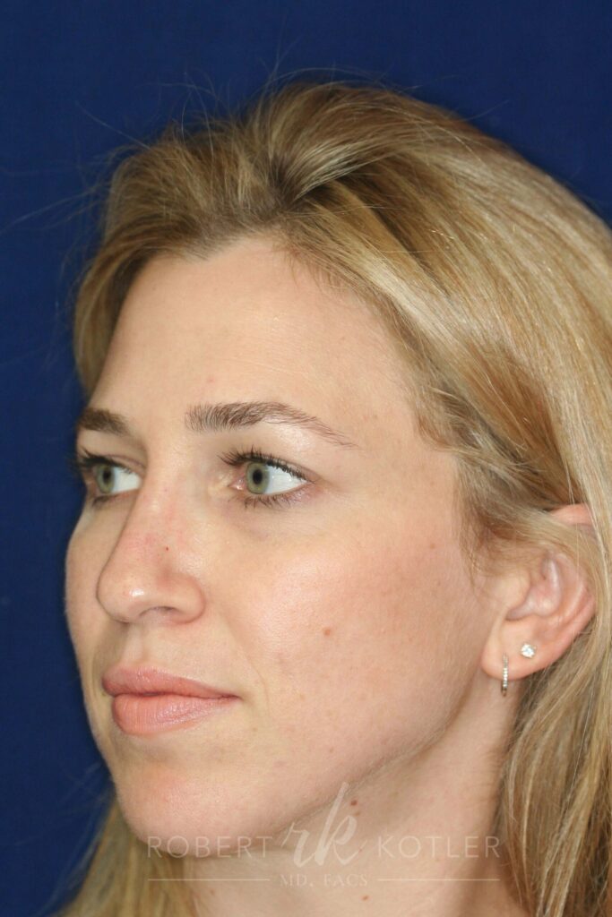 rhinoplasty-beverly-hills-ca-19812