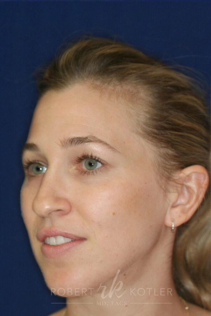 rhinoplasty-beverly-hills-ca-19813