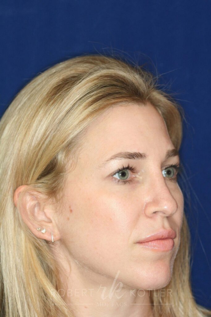 rhinoplasty-beverly-hills-ca-19814