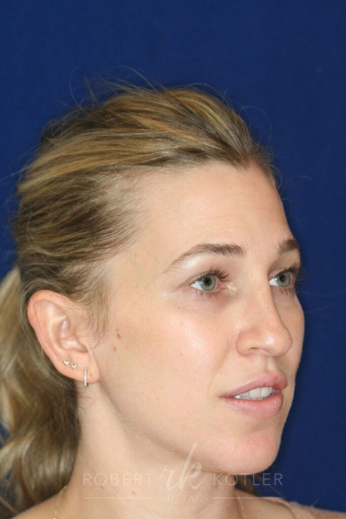 rhinoplasty-beverly-hills-ca-19815