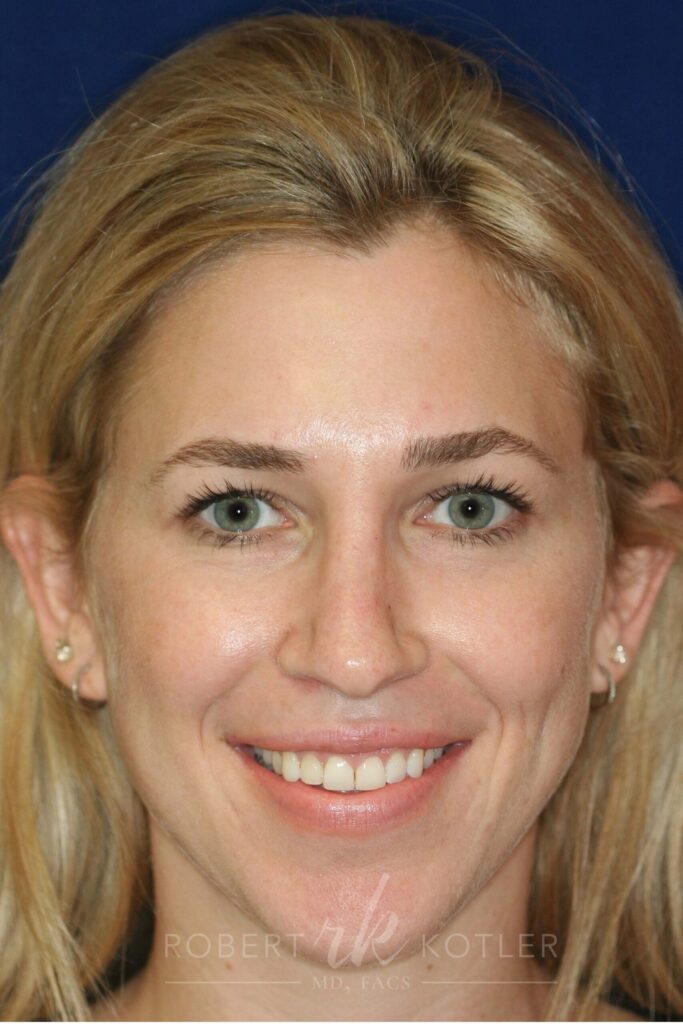 rhinoplasty-beverly-hills-ca-19816