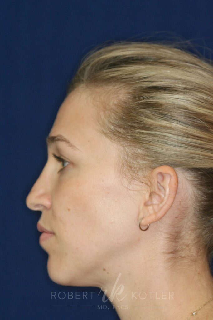 rhinoplasty-beverly-hills-ca-19819