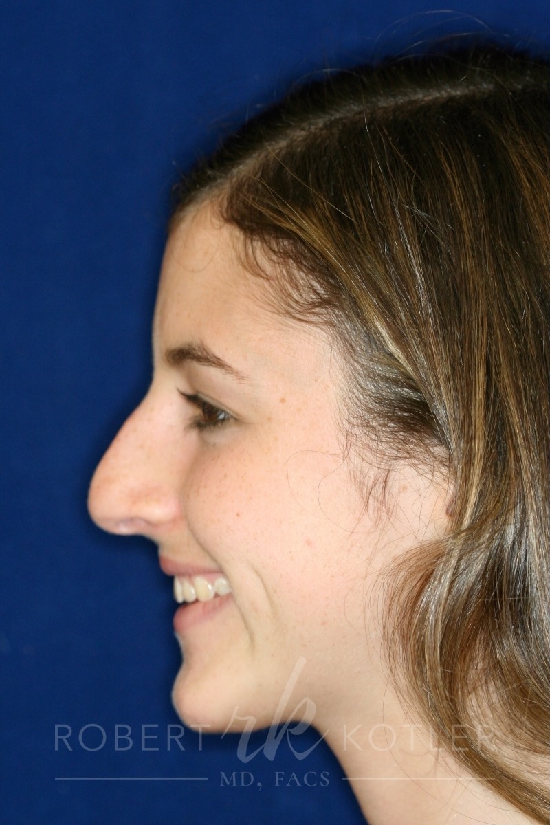 Closed Rhinoplasty - Left Profile - Before Pic - Hump removal - Tip refinement - Nose elevated from lip - Best Rhinoplasty Beverly Hills