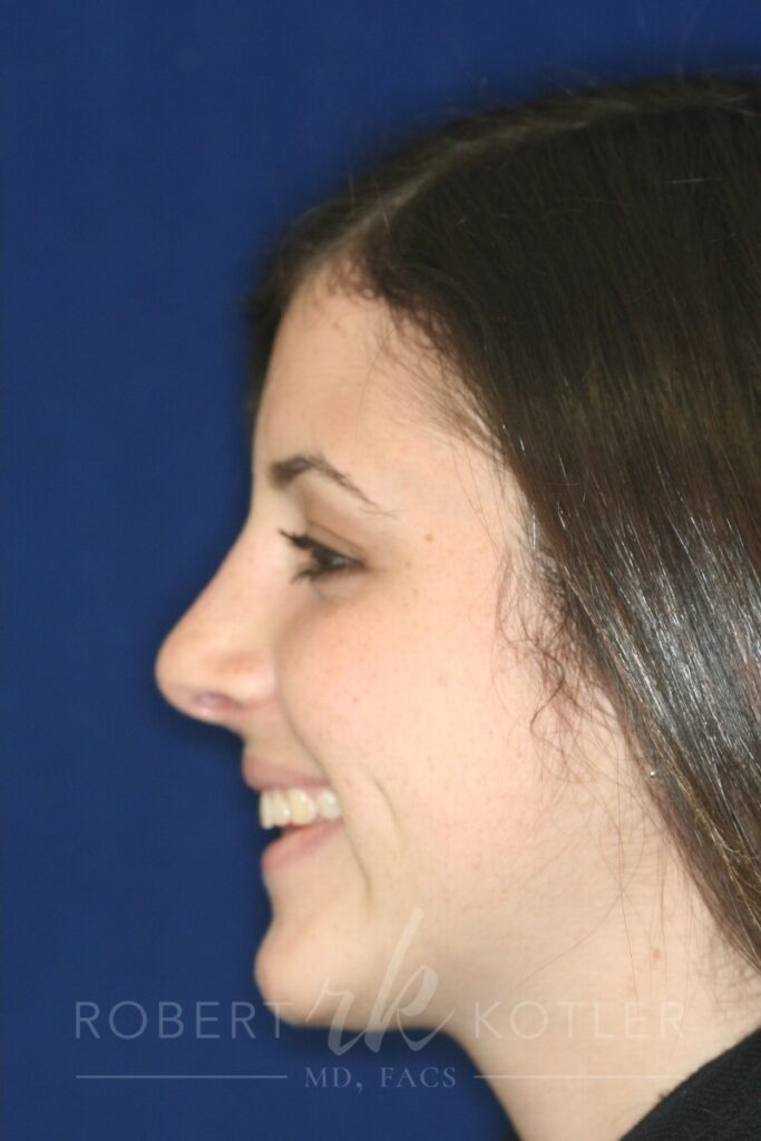 Closed Rhinoplasty - Left Profile - After Pic - Hump removal - Tip refinement - Nose elevated from lip - Rhinoplasty Surgeon in Beverly Hills