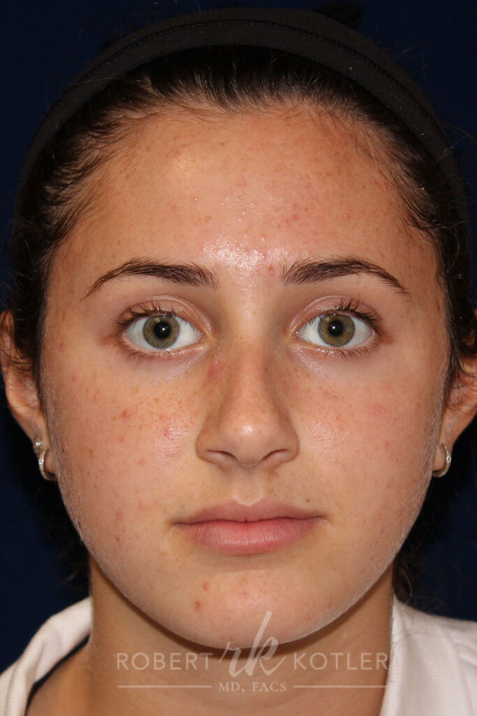 Rhinoplasty - Front Face View - Before Pic - Hump removal - Tip correction and refinement - Rhinoplasty Surgeon in Beverly Hills