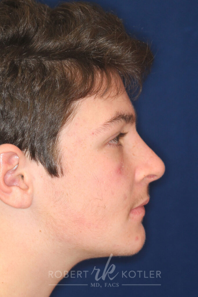 Rhinoplasty - Right Profile - After Pic - Total nose reconstruction - Hump removal - Nose recessed- Blocked breathing corrected - Best Nose Job Surgeon