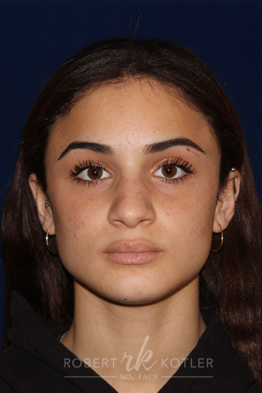 Rhinoplasty - Front Face View - Before Pic - Bump lowered - nose and lip angle slightly increased - tip refined - Beverly Hills Rhinoplasty Superspecialist
