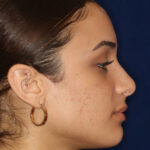 Rhinoplasty - Right Profile - After Pic - Bump lowered - nose and lip angle slightly increased - tip refined - Nose Job in Beverly Hills