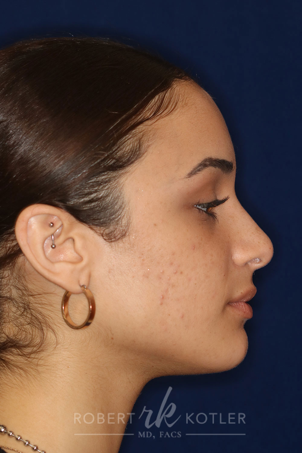 Rhinoplasty - Right Profile - After Pic - Bump lowered - nose and lip angle slightly increased - tip refined - Nose Job in Beverly Hills