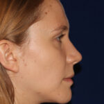 Rhinoplasty - Right Profile - After Pic - Narrowing of the nose - narrowing of bony and cartilaginous structure - Best Rhinoplasty Beverly Hills