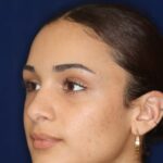 Rhinoplasty - Right Profile - Before Pic - Bump lowered - nose and lip angle slightly increased - tip refined - Rhinoplasty Surgeon in Beverly Hills