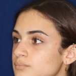 Rhinoplasty - Right Profile - Before Pic - Bump lowered - nose and lip angle slightly increased - tip refined - Rhinoplasty Surgeon in Beverly Hills