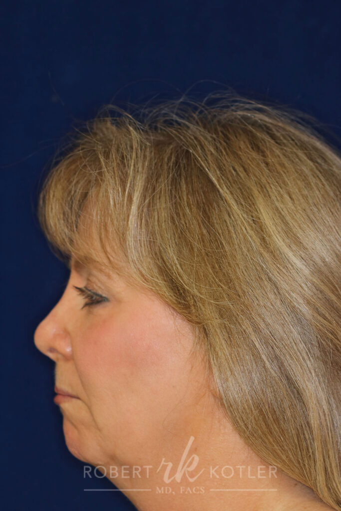 Permanent Non-surgical Revision Rhinoplasty - Left Profile - After Pic - Permanent filler - Nose tip refined - Nose bridge raised - Rhinoplasty Surgeon in Beverly Hills