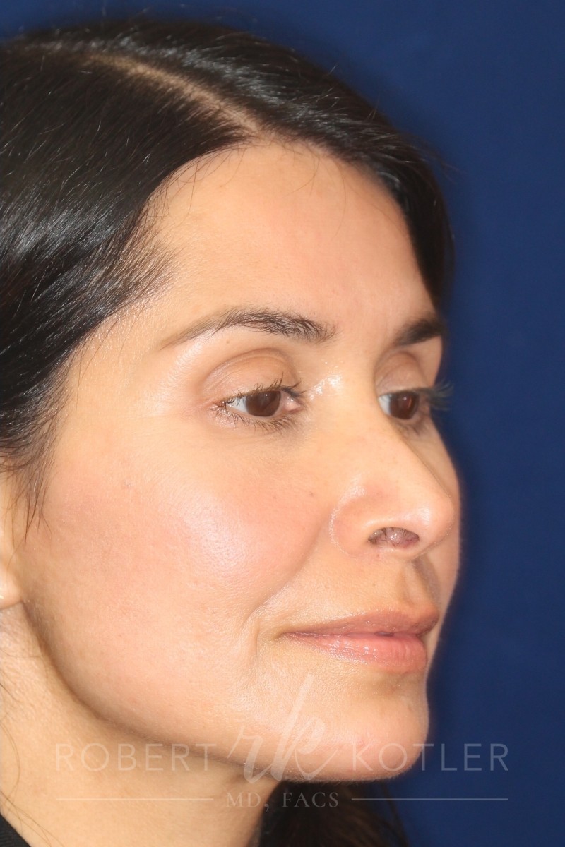 Closed Rhinoplasty - Right Profile - After Pic - Columella elevation - Hump removal - Nose tip refinement - Best Nose Job Surgeon