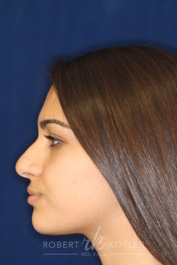 Rhinoplasty - Left Profile - Before Pic - Hump removal - Nose recessed closer to the face - Nose tip refined - Best Nose Job Surgeon