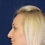 Closed Rhinoplasty - Right Profile - Before Pic - wide nose narrowing - flat nose with tip refinement -Best Rhinoplasty Beverly Hills