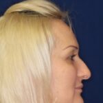 Closed Rhinoplasty - Left Profile - Before Pic - wide nose narrowing - flat nose with tip refinement - Top Rhinoplasty Surgeon