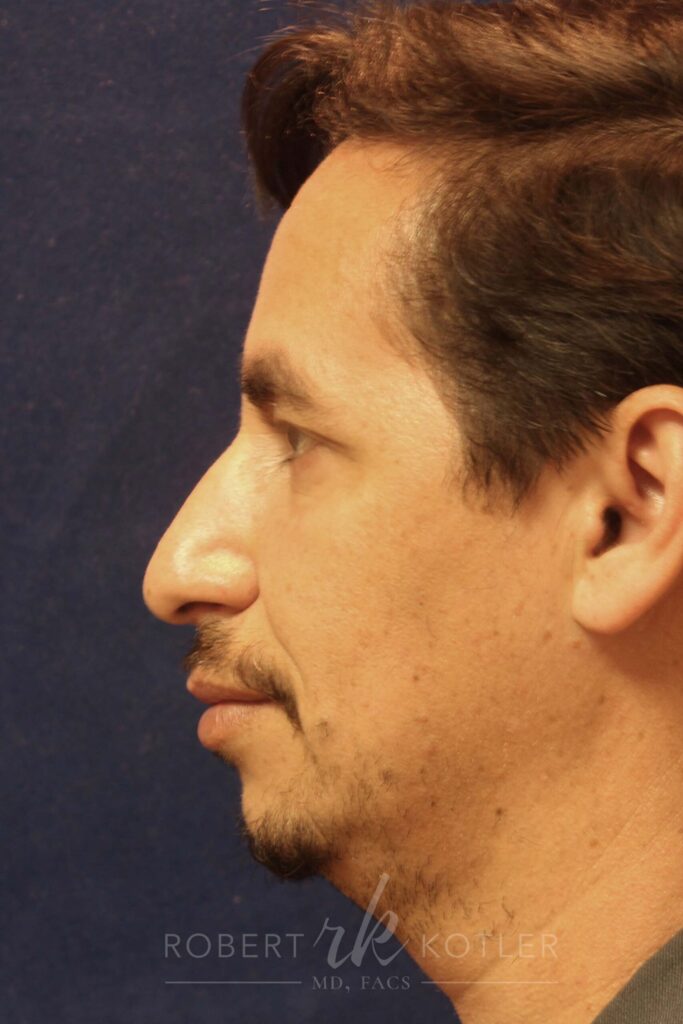 Closed Rhinoplasry - Left Profile - Before Pic - Correction of crooked nose - Hanging tip elevated - Tip refinement - Rhinoplasty Surgeon in Beverly Hills