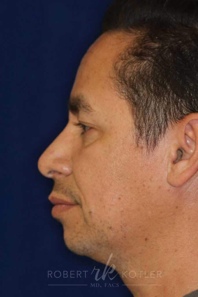 Closed Rhinoplasty - Left Profile - After Pic - Correction of crooked nose - Hanging tip elevated - Tip refinement - Nose Job in Beverly Hills