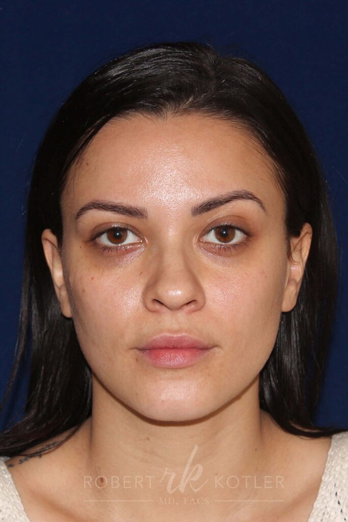 Closed Rhinoplasty - Front Face View - Before Pic - Hump removal - Nose tip refinement - Beverly Hills Rhinoplasty Superspecialist