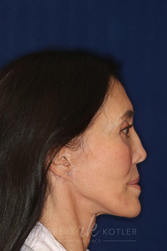 Permanent Non-Surgical Revision Rhinoplasty