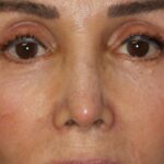 Permanent Non-Surgical Revision Rhinoplasty