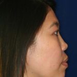 Permanent non-surgical rhinoplasty - Right Profile - After Pic - Permanent filler - Pre-injury appearance restored - Beverly Hills Rhinoplasty Superspecialist